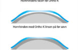 Sådan virker Ortho-K kontaktlinser - linser til at sove med