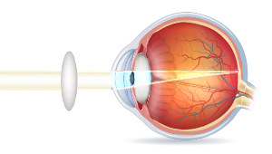 Tværsnt af øjeæble med korrigeret gammelmandssyn